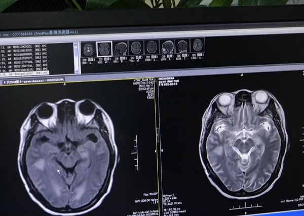 Mo ga lam co, benh nhan khon kho vi viem mang nao, suyt tu vong-Hinh-2