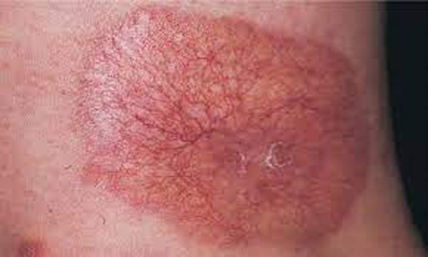 Ngứa da. Ngoài ngứa tai, lượng đường trong máu tăng cao còn khiến bạn cảm thấy ngứa râm ran dưới da. Đáng tiếc, tình trạng này rất hay nhầm lẫn với dị ứng và thường xuyên bị bỏ qua.