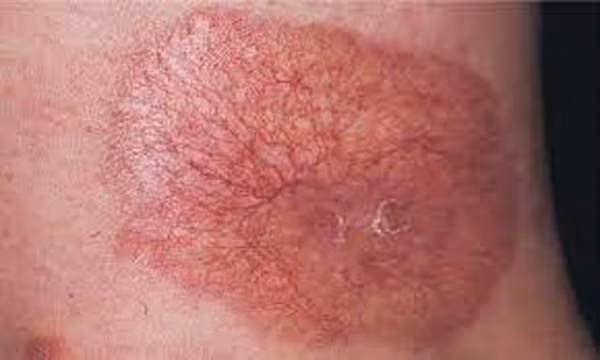 Ngứa da. Ngoài ngứa tai, lượng đường trong máu tăng cao còn khiến bạn cảm thấy ngứa râm ran dưới da. Đáng tiếc, tình trạng này rất hay nhầm lẫn với dị ứng và thường xuyên bị bỏ qua.