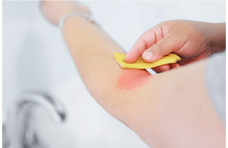 Tương tự ta có thể làm dịu vết muỗi đốt.