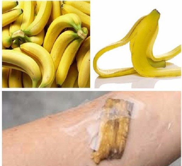 Trước khi đi ngủ, hãy đặt một miếng vỏ chuối lên trên nốt mụn và dùng băng quấn lại. Lặp lại mẹo này mỗi đêm và mụn cơm sẽ tự rụng.