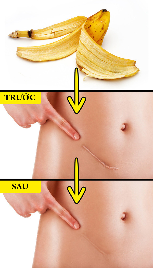 Vỏ chuối có "cả kho" tác dụng tuyệt vời hơn cả thuốc. Vỏ chuối chứa nhiều axit béo, có khả năng làm mờ sẹo. Hãy đắp lên vùng da có sẹo để qua đêm, sáng hôm sau rửa lại bằng nước sạch.