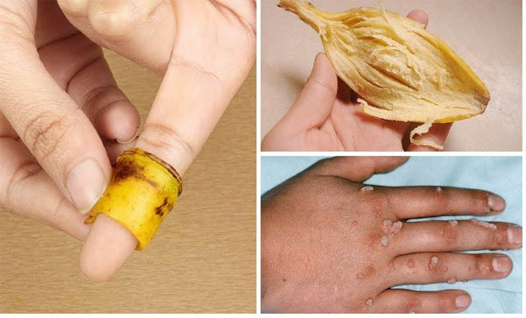 Vỏ chuối có thể chữ mụn cóc mà không gây đau đớn gì.