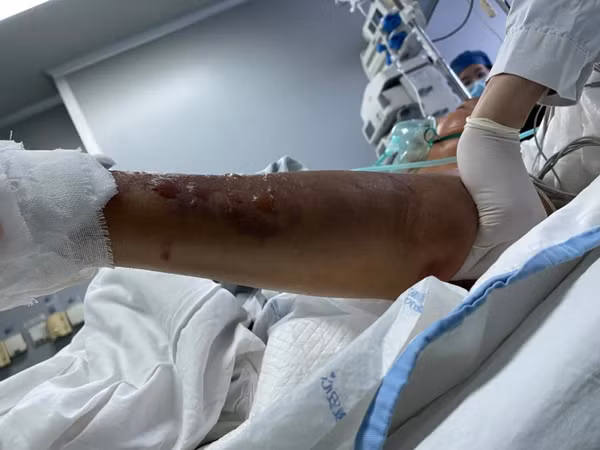 Rua ca, lao ngu nhiem vi khuan xam nhap, buoc cat bo 1 chi-Hinh-3