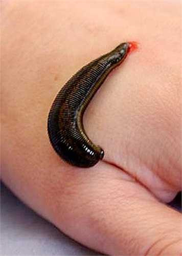 Từ thời cổ đại, một số nền văn minh như Hy Lạp, Ai Cập... đã sử dụng đỉa hút máu bệnh nhân để điều trị các bệnh như đông máu, làm giảm áp lực tĩnh mạch để giảm sưng, kích thích lưu thông máu và điều trị một số loại viêm xương khớp...