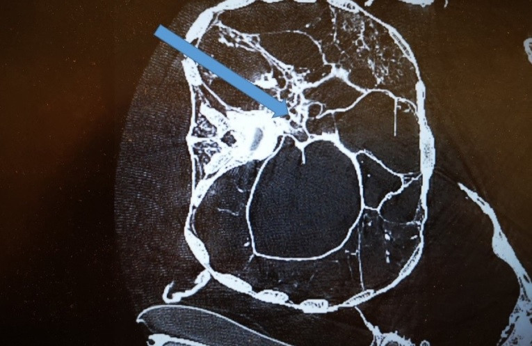Cụ thể, kết quả phân tích bằng 3D-CT chỉ ra người đàn ông trên tử vong do cú đánh chí mạng vào đầu và bị đâm vào lưng trong lúc đang đứng hoặc quỳ. Những vết thương nghiêm trọng này gây ra bởi một hoặc hai kẻ tấn công vào khoảng năm 996 - 1147.