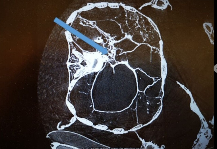 Phổi của người đàn ông có vết sẹo do từng mắc bệnh lao nặng nhưng không phải nguyên nhân tử vong. Nhóm nghiên cứu nhận định nguyên nhân dẫn tới cái chết của người này đến từ hành vi bạo lực.
