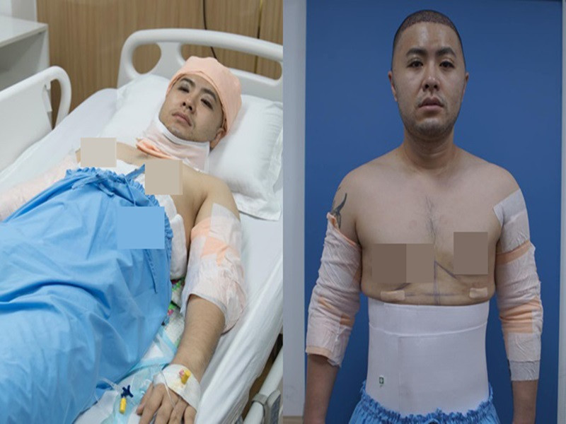 Vì bị stress cực độ khi mỗi lần gặp khán giả đều bị chê mập, Akira Phan quyết định dao kéo. Nam ca sĩ "Mùa đông không lạnh" chi 300 triệu hút mỡ, cằm, cánh tay và sửa lại mí mắt. Ảnh: Dân Việt