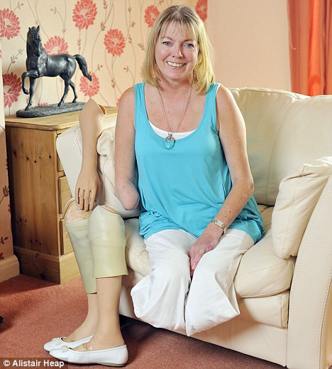 Cô Jane Knight mất hai chân và 1 tay vì bệnh tiểu đường.