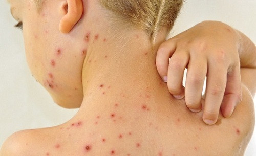 Bệnh Zona: Siêu vi varicella-zoster gây ra thủy đậu có thể ẩn trong tế bào thần kinh và kích hoạt trở lại, phát triển thành bệnh zona sau nhiều năm. Bệnh có các biến chứng riêng, gọi là đau thần kinh sau zona.