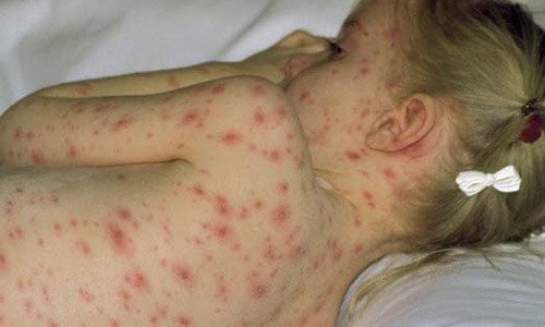 Bệnh Zona: Siêu vi varicella-zoster gây ra thủy đậu có thể ẩn trong tế bào thần kinh và kích hoạt trở lại, phát triển thành bệnh zona sau nhiều năm. Bệnh có các biến chứng riêng, gọi là đau thần kinh sau zona.