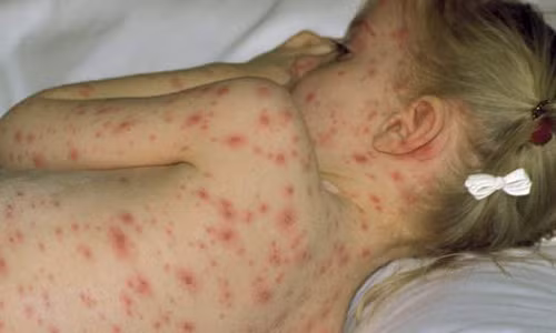 Bệnh Zona: Siêu vi varicella-zoster gây ra thủy đậu có thể ẩn trong tế bào thần kinh và kích hoạt trở lại, phát triển thành bệnh zona sau nhiều năm. Bệnh có các biến chứng riêng, gọi là đau thần kinh sau zona.