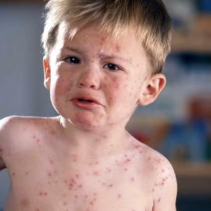 Đây cũng là giai đoạn người bệnh dễ mắc các biến chứng nguy hiểm nếu không có sức đề kháng tốt và điều trị đúng cách. 