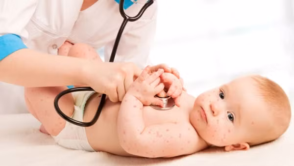 Những vết mụn đóng vẩy cũng nhanh chóng bay đi, nếu không có biến chứng sẽ không để lại sẹo. (Ảnh: Boldsky)