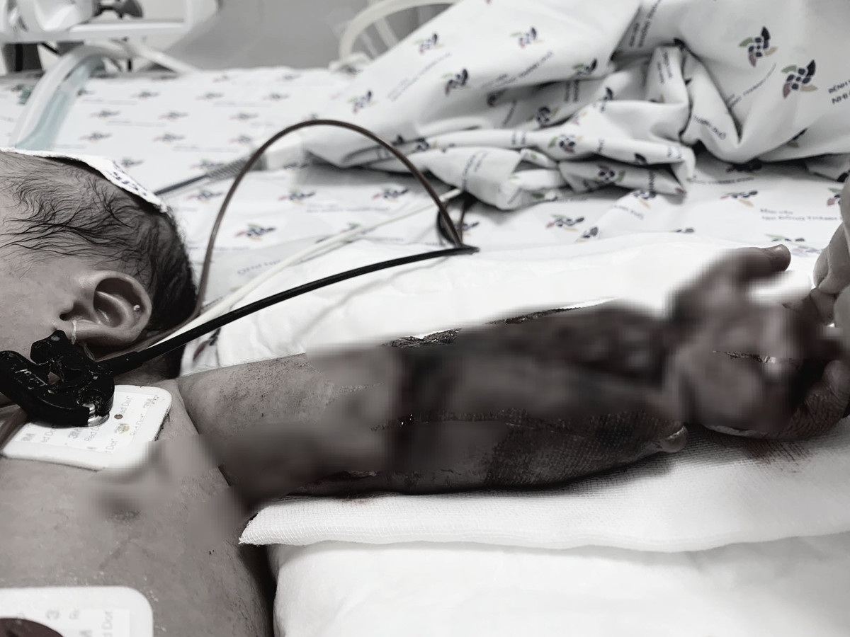 Mac vong vao may may, be moi sinh bi may nga de gay xuong canh tay