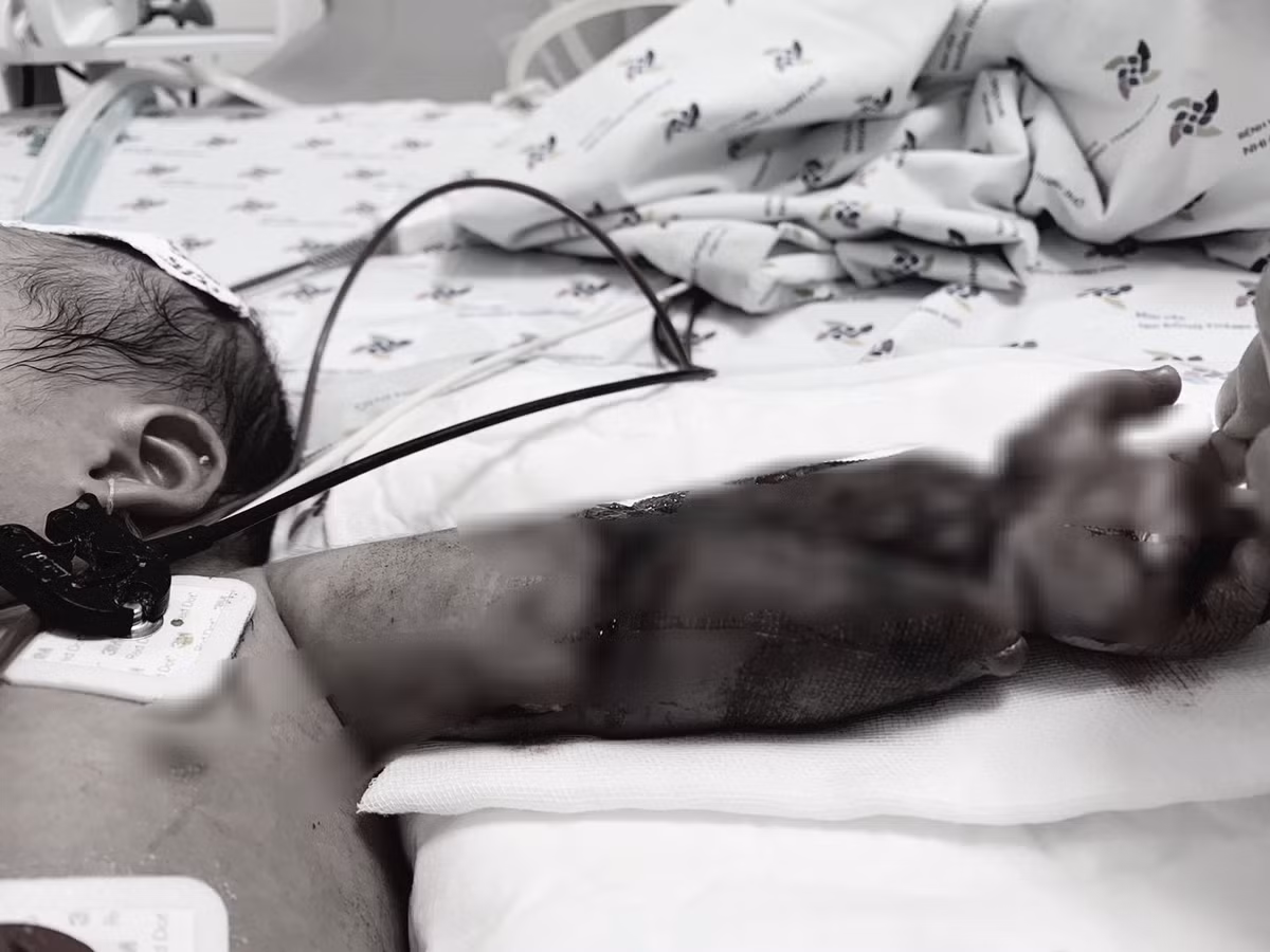 Mac vong vao may may, be moi sinh bi may nga de gay xuong canh tay