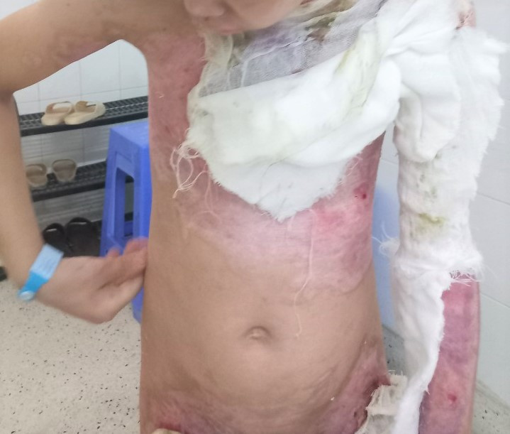 TP HCM: Lien tiep hai tre nho bi bong do con va xang