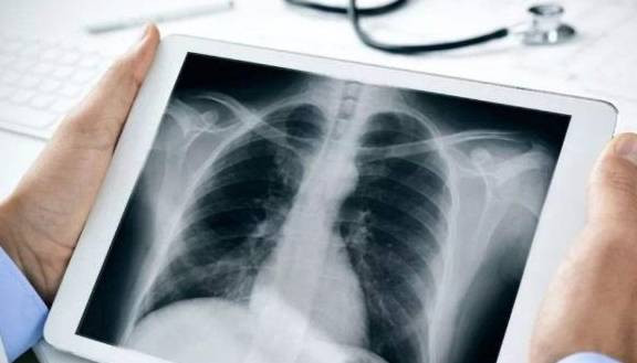 Dot nhien ho, sot kieu nay, di kham ung thu phoi ngay