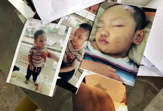 Ảnh cháu bé nghi bị chính mẹ ruột bạo hành. Nguồn ảnh: Công Lý