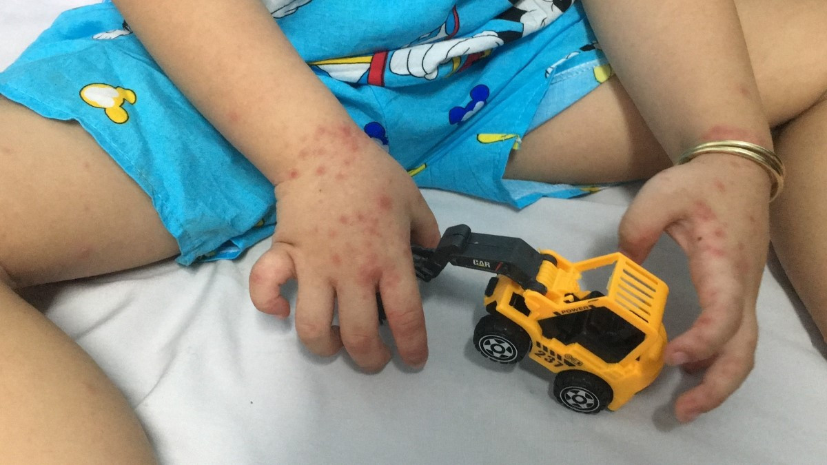 Ha Noi co 313 ca mac tay chan mieng trong tuan qua