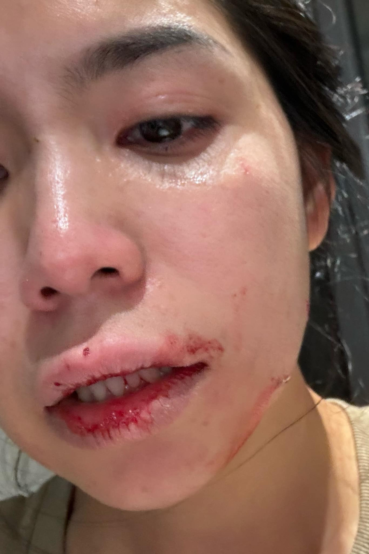 Câu chuyện Tôn Bằng từng bạo hành vợ cũ khiến nhiều người liên tưởng đến trước đó không lâu, Hằng Du Mục cũng bị chính Tôn Bằng bạo hành. Cô từng xuất hiện với hình ảnh gương mặt đầy thương tích.