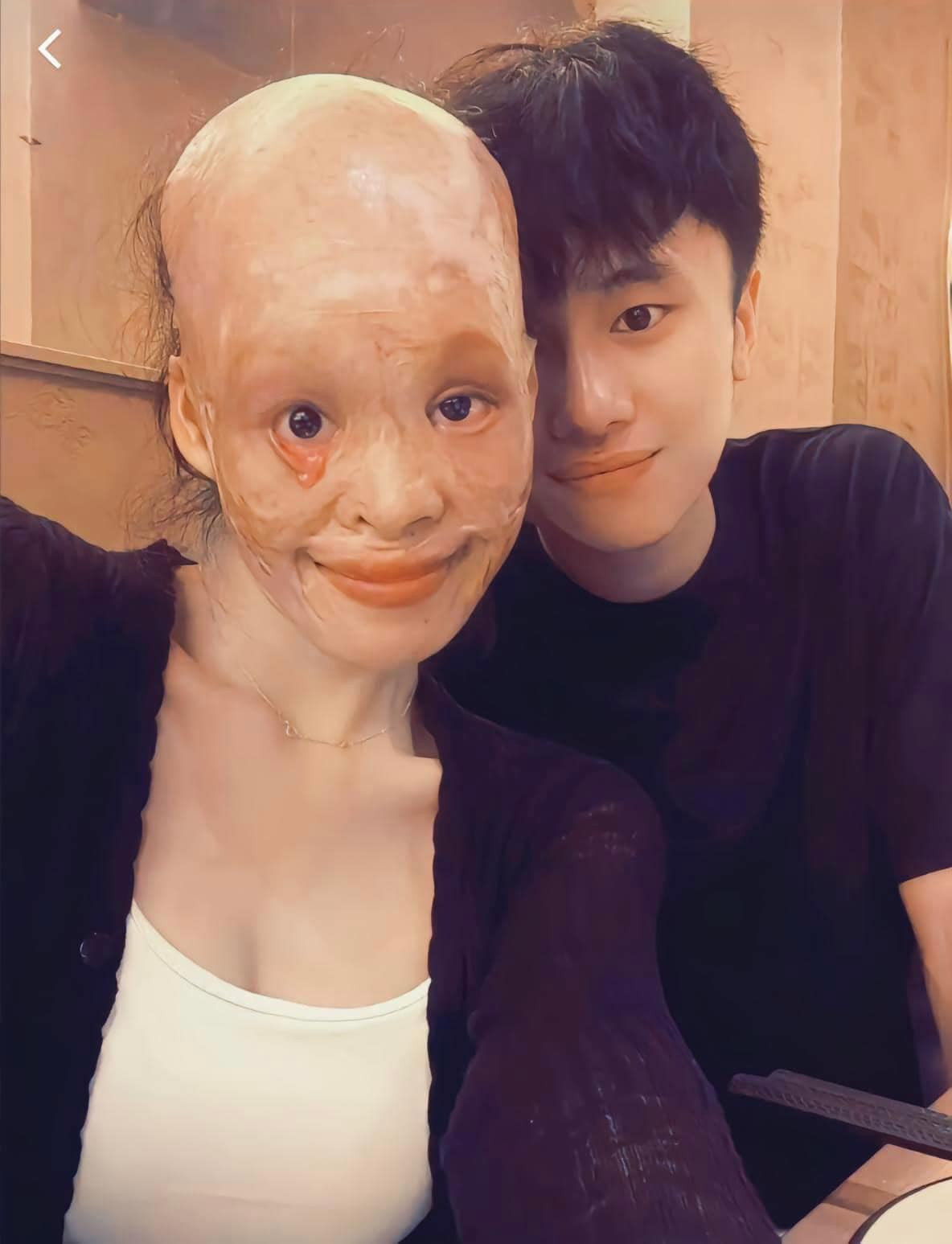 Nhiều giả thuyết đã được đặt ra, có người cho rằng cô gái do cứu mẹ của bạn trai trong hỏa hoạn nên dung mạo mới bị phá hủy khốc liệt như vậy.