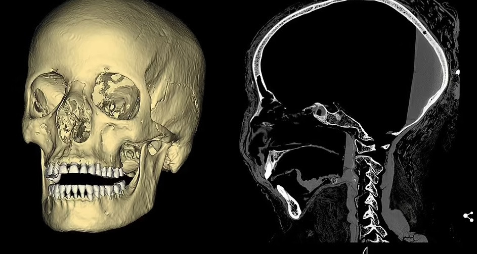 Đây là loại ung thư hiếm gặp, tác động tới phần họng nằm giữa vùng sau mũi và sau miệng của người bệnh.
