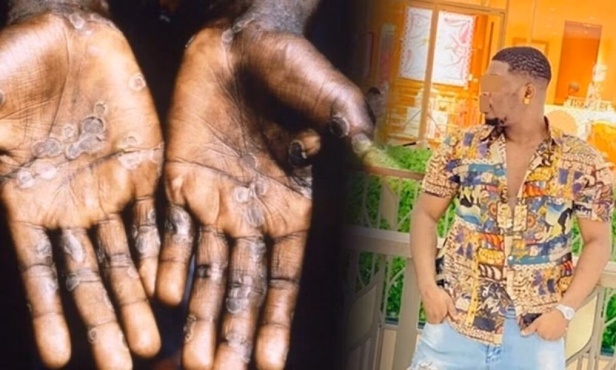 Ca benh dau mua khi dau tien tai Thai Lan da tron sang Campuchia