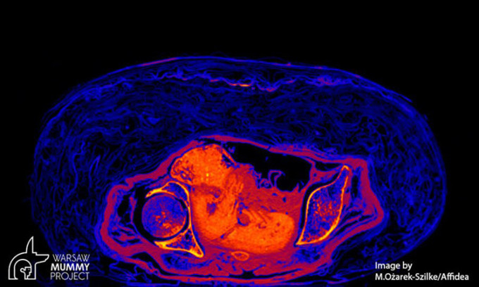 Thế nhưng, khi chụp cắt lớp xác ướp, họ phát hiện đó là thi hài một phụ nữ qua đời trong độ tuổi 20 - 30 và đang mang thai 26 - 30 tuần.