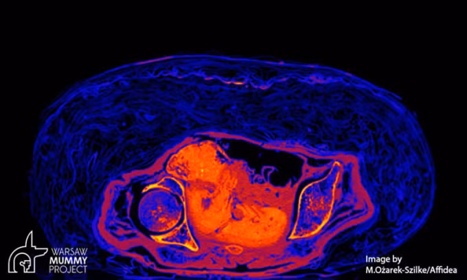Thế nhưng, khi chụp cắt lớp xác ướp, họ phát hiện đó là thi hài một phụ nữ qua đời trong độ tuổi 20 - 30 và đang mang thai 26 - 30 tuần.