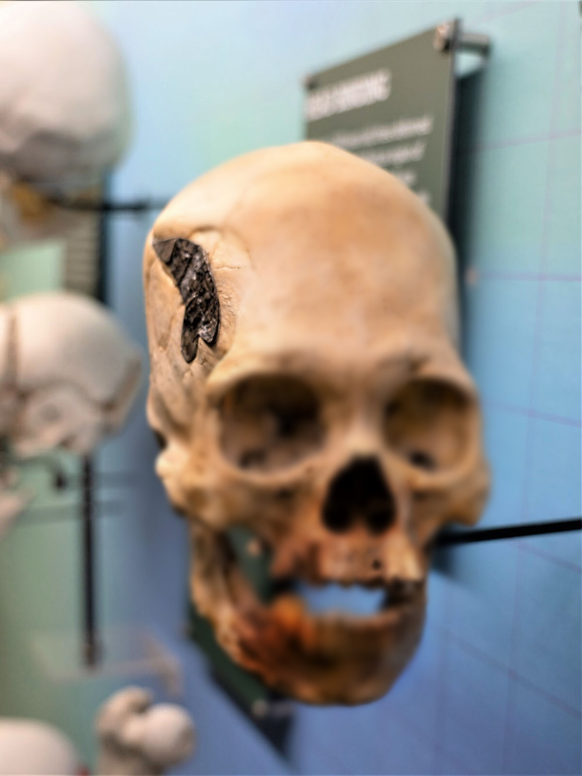 Hiện các chuyên gia chưa thể xác định thành phần chính xác của miếng kim loại gắn trên hộp sọ. Họ suy đoán người xưa có thể dùng vàng hoặc bạc cho những ca phẫu thuật kiểu này.