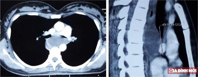 Bi nghen co, di kham phat hien to ken phe quan