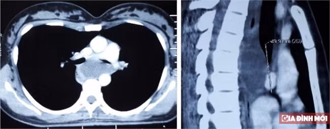 Bi nghen co, di kham phat hien to ken phe quan