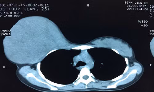 Xuc dong me tri hoan phau thuat khoi u "khung" de sinh con