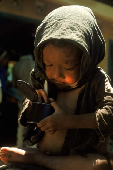 Bé trai bốn tuổi gầy gò, suy dinh dưỡng đang ăn một khẩu phần ăn gồm thịt gà và mì.