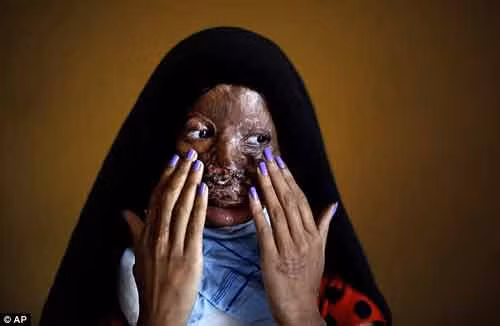 Khuôn mặt người phụ nữ này biến dạng hoàn toàn do Axit. Ảnh: ĐSPL