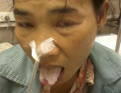 Một nạn nhân bỏng rộp lưỡi do uống nhầm axit. Ảnh: VTC