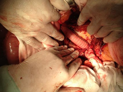 Một ca phẫu thuật mạch máu. (Ảnh minh họa)