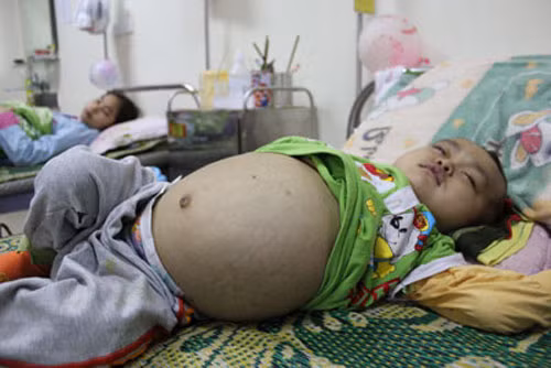 Nhiễm giun sán. Giun sán xâm nhập vào cơ thể bằng đường ăn uống. Do bệnh nhân ăn phải nguồn thịt heo hoặc uống nước chứa ấu trùng không được nấu chín. Ấu trùng sán sau khi đi vào đường tiêu hóa sẽ vỡ ra, tấn công đến các cơ quan khác như não, da, mắt… Quá trình ấu trùng khu trú lâu có thể tạo thành nang lớn. Ảnh: Suckhoetongquat