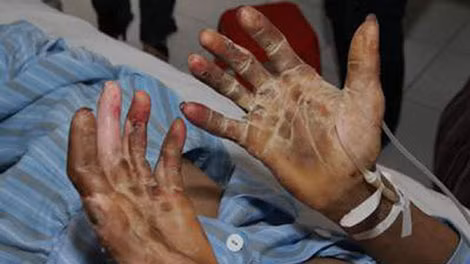 Ở thể viêm màng não, bệnh nhân có sốt cao trên 39 độ C, đau đầu dữ dội, nôn, ù tai, chân tay lạnh, rét run, cứng gáy, rối loạn tri giác, lơ mơ dần dẫn đến hôn mê và nếu được cứu sống cũng để lại di chứng ù tai, điếc tai, mất trí nhớ. Ngoài ra, có những trường hợp mắc cùng lúc cả hai thể bệnh này khiến tình trạng bệnh rất nguy kịch.