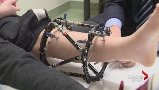 Khi phẫu thuật kéo dài chân, người thực hiện có thể sẽ gặp một số biến chứng như: Đau do phẫu thuật. Cơn đau này sẽ giảm dần sau khoảng 2-3 tuần. Sau khi phẫu thuật, các dây thần kinh, cơ gân cần có thời gian phục hồi và thích ứng với môi trường mới; Trật khớp: Tình trạng xương căng ra mà các phần mềm lại đáp ứng không kịp, bị co rút dẫn đến việc trật khớp.