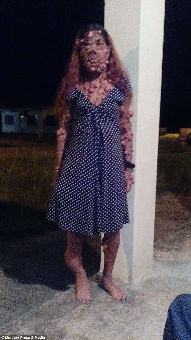 Charmaine đã thực hiện hai cuộc phẫu thuật để loại bỏ khối u. Thế nhưng chúng mọc lại nhanh chóng. Các bác sĩ ở Trinidad đã bất lực với tình trạng của Charmaine. Charmaine cũng cho biết cô sẵn sàng ra nước ngoài để được giúp đỡ. Dù hoàn cảnh khó khăn, tồi tệ, lại phải chịu đựng nhiều lời ác ý, nhiều thái độ kỳ thị, thế nhưng Charmaine cho biết mình vẫn rất lạc quan. Cô hy vọng rằng sẽ gặp được người hảo tâm, bệnh tình sẽ tiến triển tốt và một lần nữa được sống cuộc sống bình thường. Sự ác cảm đã làm tổn thương người đàn bà đáng thương, có lẽ thay vì ác cảm với cô gái, hãy cố gắng yêu thương, nhìn vào con người tốt đẹp bên trong của cô, thay vì nhìn vào bề ngoài để ác cảm.