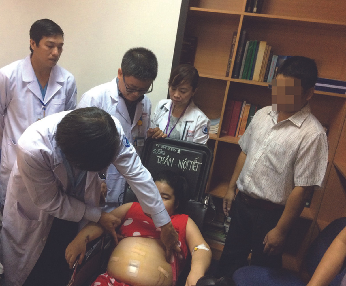 Một bệnh nhi bị hội chứng Cushing. Ảnh Sức khỏe đời sống.