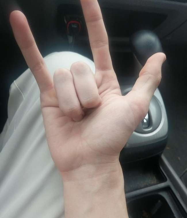 Người đàn ông này có những đốt ngón tay dài bất thường.