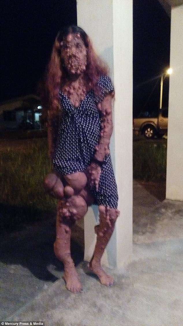 Mỗi lần đi ra ngoài, nhiều người nhìn chằm chằm vào cô, một số đứa trẻ khi nhìn thấy cô còn lập tức chạy trốn vì quá sợ hãi. Có người còn nói thẳng với Charmaine: "Nếu tôi là cô, tôi chết quách đi cho rồi".