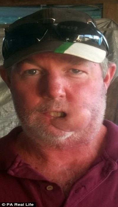 Sau khi phẫu thuật để loại bỏ phần dưới môi và miệng, ông tin căn bệnh này đã kết thúc. Tuy nhiên, đến tháng 4/2015 một khối u bắt đầu xuất hiện trở lại trên mặt nhưng bác sỹ xác định đó chỉ là u lành và kê thuốc cho ông uống.