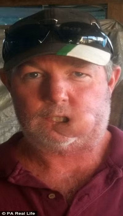 Sau khi phẫu thuật để loại bỏ phần dưới môi và miệng, ông tin căn bệnh này đã kết thúc. Tuy nhiên, đến tháng 4/2015 một khối u bắt đầu xuất hiện trở lại trên mặt nhưng bác sỹ xác định đó chỉ là u lành và kê thuốc cho ông uống.