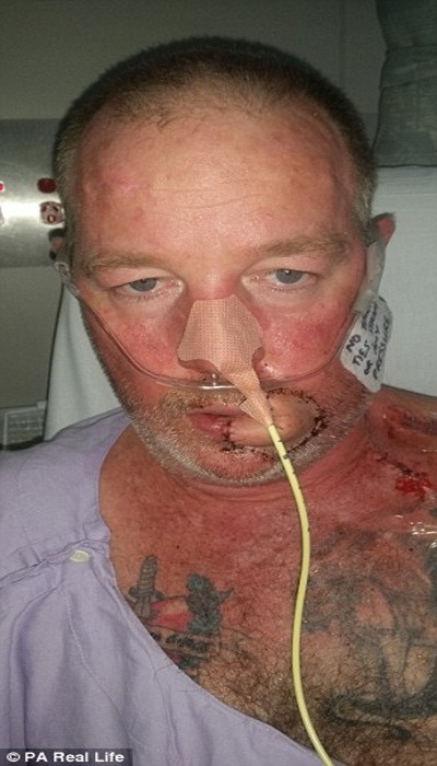 Bác sỹ lấy một phần xương mác để làm lại hàm, cùng với ghép da từ chân và trán để tạo một cái miệng mới. Bây giờ ông đã có thể ăn và nói chuyện. Trong vài tháng tới, ông sẽ được tái tạo khuôn mặt để nó trông tự nhiên hơn.