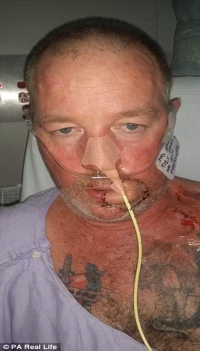 Bác sỹ lấy một phần xương mác để làm lại hàm, cùng với ghép da từ chân và trán để tạo một cái miệng mới. Bây giờ ông đã có thể ăn và nói chuyện. Trong vài tháng tới, ông sẽ được tái tạo khuôn mặt để nó trông tự nhiên hơn.