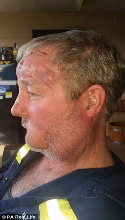 Tháng 4 năm đó thì các khối u bắt đầu phát triển và lan dần cả mặt. Lúc này, bệnh ung thư trở lại một lần nữa.